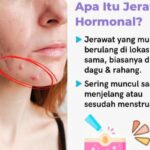 Jerawat Hormonal: Penyebab dan Solusi Tuntas dari Ahli