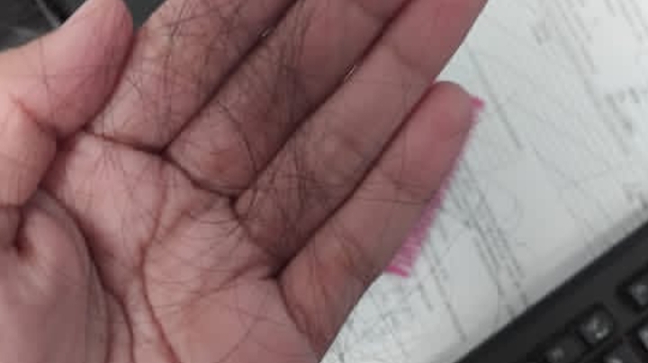 Rambut Rontok Berlebihan? Kenali 7 Penyebab dan Cara Efektif Mencegahnya